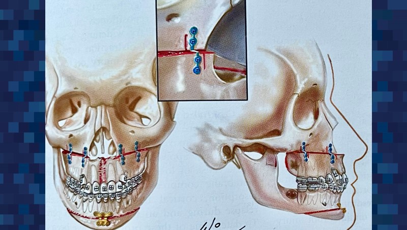 maxillo-mandibular widening illustration - Dr. Cesar Guerrero - Houston, TX
